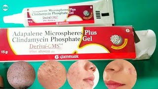 Deriva cms gel review  adapalene gel for Blackheads whiteheads acne  pimplesdarkspots पिंपल [upl. by Hortense]