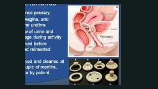 Urinary Incontinence [upl. by Atnahc992]