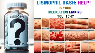 Lisinopril Rash Causes Symptoms and Relief [upl. by Maurine]