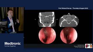 Understanding Inflammatory sinus disease nasal polyps and chronic sinusitis  Prof Richard Harvey [upl. by Aiva]