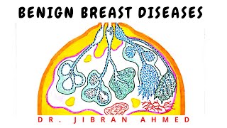 BENIGN BREAST DISEASE [upl. by Manno]