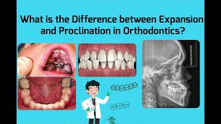 What is the Difference between Expansion and Proclination in Orthodontics [upl. by Faina]