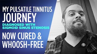 I cured my Pulsatile Tinnitus and now whooshfree diagnosed with Sigmoid Sinus Stenosis [upl. by Zerep]