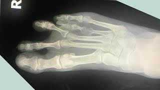 What the Heck Is It  Short Toe Syndrome [upl. by Bertie]