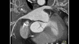 Cardiac Coronary CT Anatomy 1 of 2 [upl. by Nosittam517]