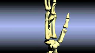 Reducing a Boxers Fracture [upl. by Esnofla]