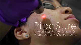 PicoSure Laser for Acne Scars amp Pigmentation [upl. by Eintruok]