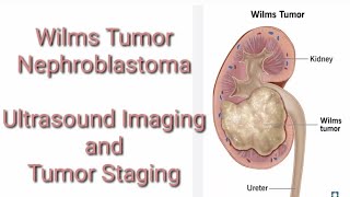 Wilms Tumour Nephroblastoma Ultrasound Imaging and tumor Staging [upl. by Treblah]