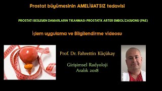 Prostatik Arter Embolizasyonu Prostat büyümesi [upl. by Aitekram]