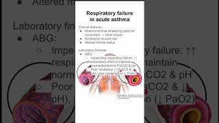 Respiratory failure in acute asthma [upl. by Kciredor]