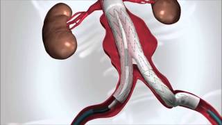 Abdominal Aortic Aneurysm [upl. by Arihppas]