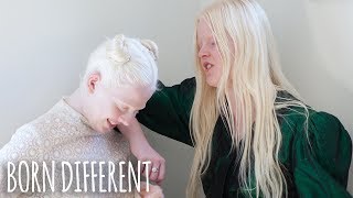 The Besties With Albinism  BORN DIFFERENT [upl. by Nikola]