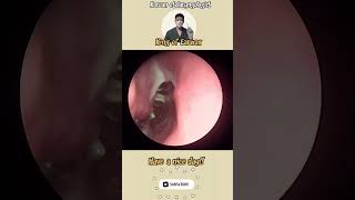 귀지형 콧물 부비동염 축농증 비염 코청소 이비인후과 rhinorrhea rhinitis sinusitis asmr ENT entdoctor [upl. by Lienad]