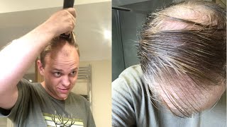 BALDING Man SHAVES Off His Biggest INSECURITY [upl. by Leinod639]