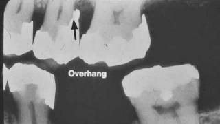 Dental Radiograph Pathology amp Restorations  Part I [upl. by Chaing]