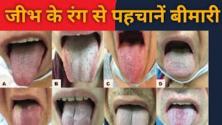 Tongue colour se pata kare bimari Jeeb ka rang Tongue colourhealth  Dr Sarika VermaWhite tongue [upl. by Selec]