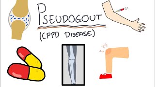 Pseudogout Calcium Pyrophosphate Disease  Simple and easy to understand [upl. by Gnuy]