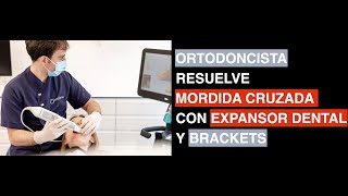 Cómo solucionar una MORDIDA CRUZADA con EXPANSOR DENTAL y BRACKETS Paso a paso [upl. by Manard]