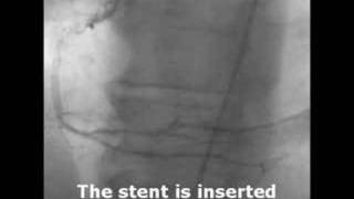 What A Diffenence A Stent Makes [upl. by Elcarim]