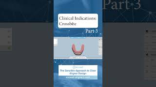 Clinical Indications Crossbite Part 3 [upl. by Airdnat253]