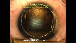 LASIK surgery explained stepbystep by Shannon Wong MD 122111 [upl. by Rubliw465]