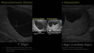 TSign amp Twin Peak Sign Lambda Sign Fetal Ultrasound Scan  Pregnancy USG shorts [upl. by Ggerg104]