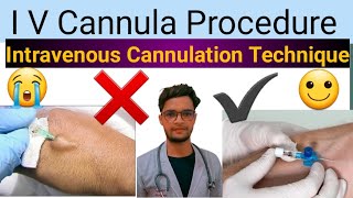 intravenous cannulation technique  I V Cannula Procedure Videos intravenousinjection cannula iv [upl. by Meneau]