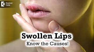 Swollen Lips Common CausesTriggers  Angioedema  Dr Rashmi Ravindra  Doctors Circle [upl. by Rabassa]