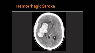 Atherosclerosis Hemorrhagic Stroke Ischemic Stroke amp Transient Ischemic Attack TIA [upl. by Turley]