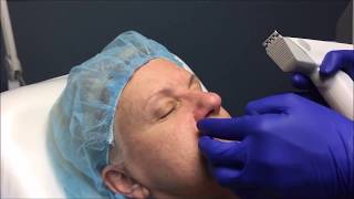 Profound RF Plus NonSurgical Skin Tightening [upl. by Ettenhoj94]