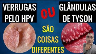 Diferenças entre VERRUGAS PELO HPV e GLÂNDULAS DE TYSON [upl. by Donn]