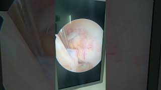 ACL ganglion cystkeyhole surgery arthroscopic decompression kneearthroscopy acl ganglioncyst [upl. by Dori]