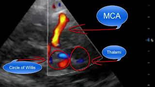 Transcranial Doppler Point of Care Ultrasound [upl. by Gerger]