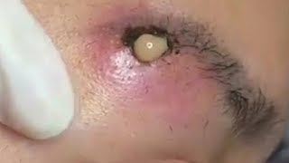 Big Cystic Acne Blackheads Extraction Blackheads amp Milia Whiteheads Removal Pimple Popping 099 [upl. by Zindman469]