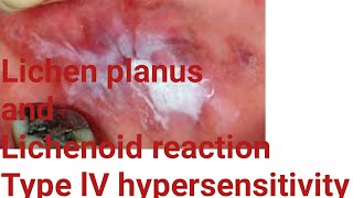 Difference between Lichen planus and Lichenoid reaction pathogenesis of lichen planus and lichenoid [upl. by Nawuj]