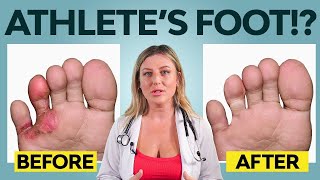 5 Ways to get Rid of Athletes Foot  Treatment [upl. by Ricki]