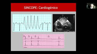 SINCOPE Y ESTIMULACION CARDIACA [upl. by Mahmoud]