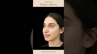 Résultat après rhinoplastie ultrasonique par Dr Abbou [upl. by Etyam263]