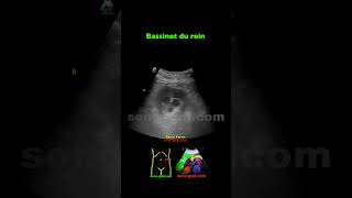 Échographie  Congestion rénale du deuxième degré [upl. by Nairrad]