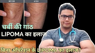 Doctor Explains Lipoma  Treatment without surgery and with surgery । LIPOMA का इलाज बिना ऑपरेशन के [upl. by Esli]