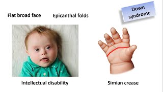 Birth defects Chromosomal abnormalities in Bangla  Monosomy  Trisomy  Translocation  Mosaicism [upl. by Teilo]