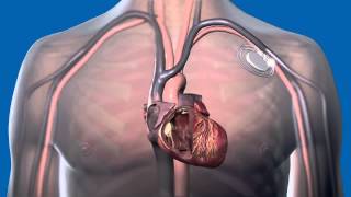 What Is a Pacemaker and How Does It Work [upl. by Archer]