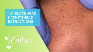 Blackhead amp Whitehead Extractions on quotKquot  April 2022 [upl. by Sido]