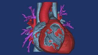 Case 29  Tetralogy of Fallot [upl. by Enytsirk]