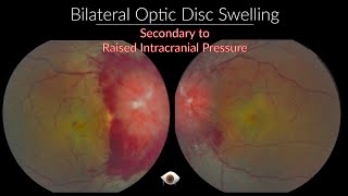 Papilloedema  Optic Nerve swelling [upl. by Assirek]