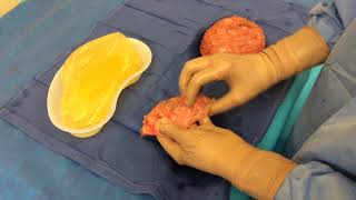 En Bloc removal of ruptured breast implant [upl. by Ramraj812]