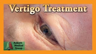 Vertigo Treatment  Auburn Medical Group [upl. by Steen]