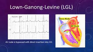 ECG I ACCESSORY PATHWAY I LGL [upl. by Viviane]