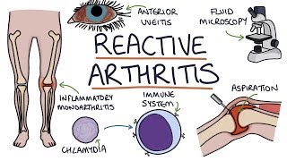 Understanding Reactive Arthritis [upl. by Perloff309]