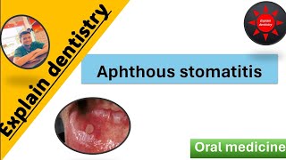 Aphthous stomatitis Lecture  Introduction  classification clinical features etiology Management [upl. by Auoy]